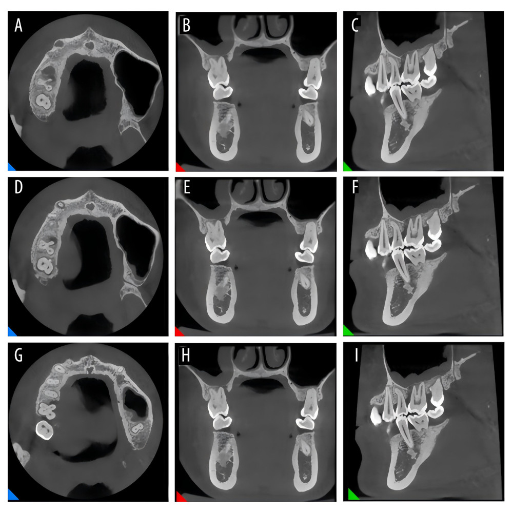 The CBCT imaging of the right maxillary first molar before treatment (A–C: images of the apical third of the root, D–F: images of the middle third of the root, G–I: images of the cervical third of the root).