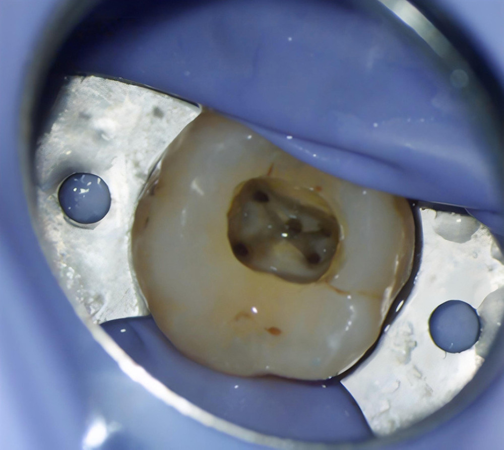 Microscopic evaluation of the spatial distribution of 5 root canal orifices in tooth 16.