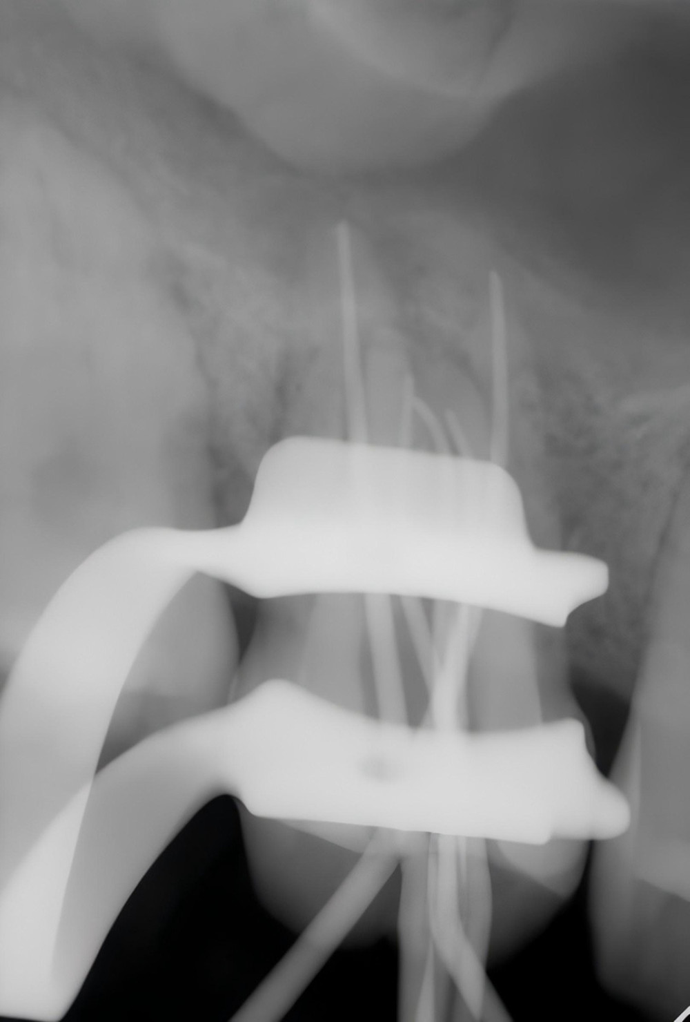 The working length verification radiograph of tooth 16.