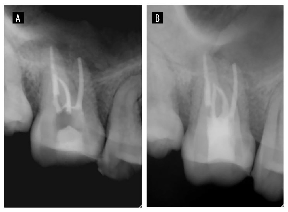 Periapical radiographs taken immediately after root canal filling (A) and after permanent coronal restoration (B).