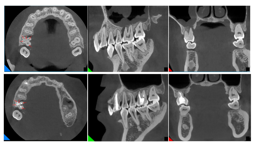 Imaging evaluation of tooth 16 before and after treatment. Cross-sectional view showing the 5 obturated canals (red arrows).