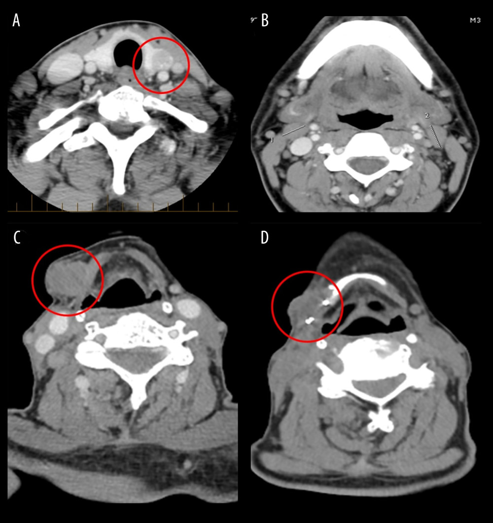 CT imaging showing the progression of neck soft tissue masses. In 2002, a 12-mm nodule was identified in the left thyroid lobe (A), along with multiple bilateral nodes suggestive of metastases, the largest in the jugulodigastric and right omohyoid regions measuring 16 mm (B). Images from 2025 after remission reveal a well-defined 1.9 × 1.7 × 1.5 cm lesion inferior to the right submandibular space, suspected enlarged lymph node with extracapsular extension (C). Postsurgical imaging shows resection of a right cervical sarcomatous mass between the right hyoid and thyroid cartilages (D).