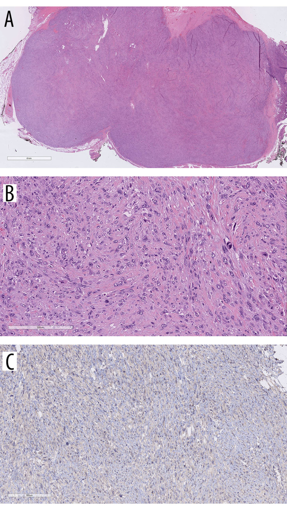 Histopathology of the resected mass. A 4.0-cm relatively well-circumscribed tumor was excised (A). The tumor displays a pattern less arrangement of atypical spindled cells with no identifiable line of differentiation (B). Immunohistochemical stains confirm no evidence of thyroid cell differentiation and no reactivity for calcitonin depicted (C).