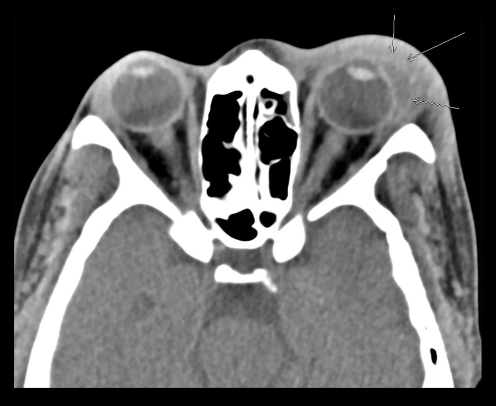 Computed tomography of the orbits and sella without contrast. Significant left periorbital swelling and edema are present without a discrete collection. Convex fluid attenuation and air are noted adjacent to the left lateral globe (arrows).