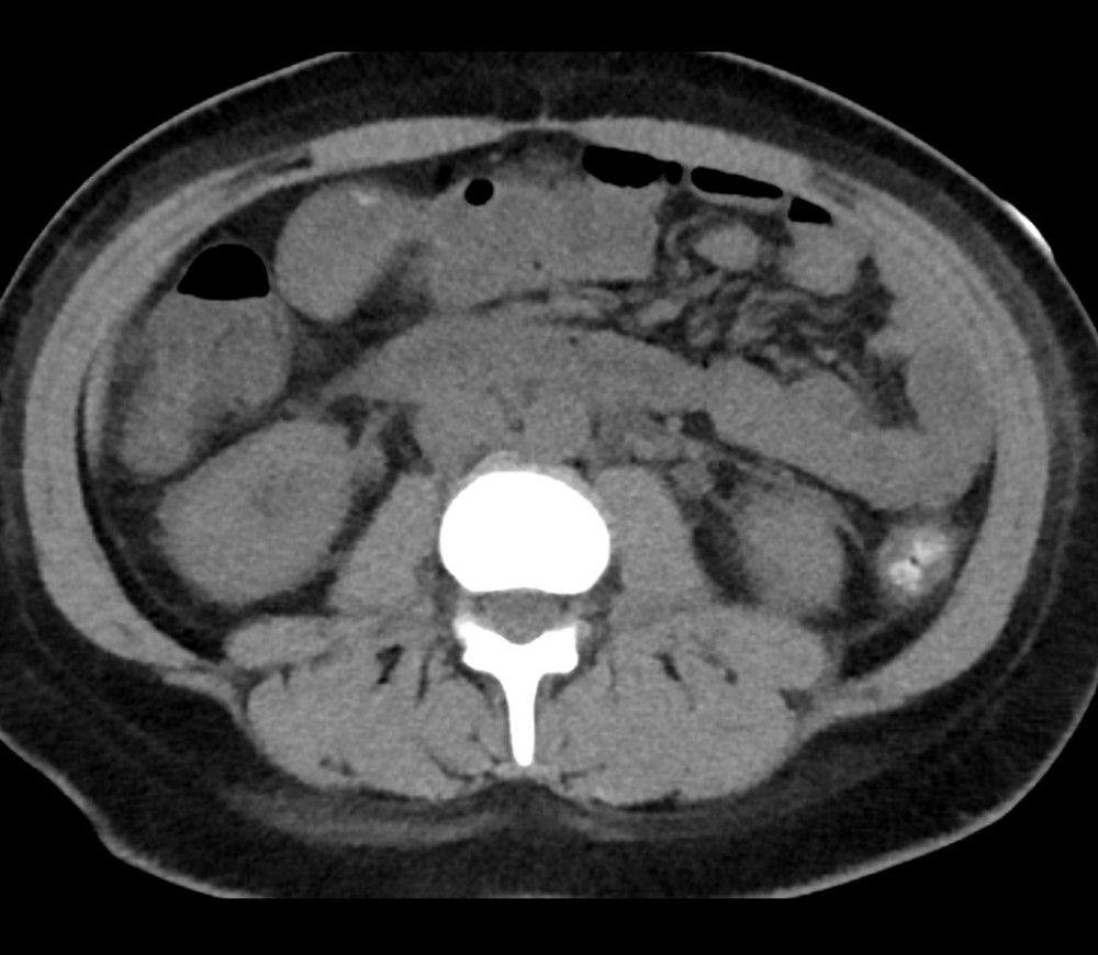 Computed tomography of the abdomen and pelvis without contrast. Mesenteric edema and a small amount of free fluid are present without evidence of bowel obstruction.