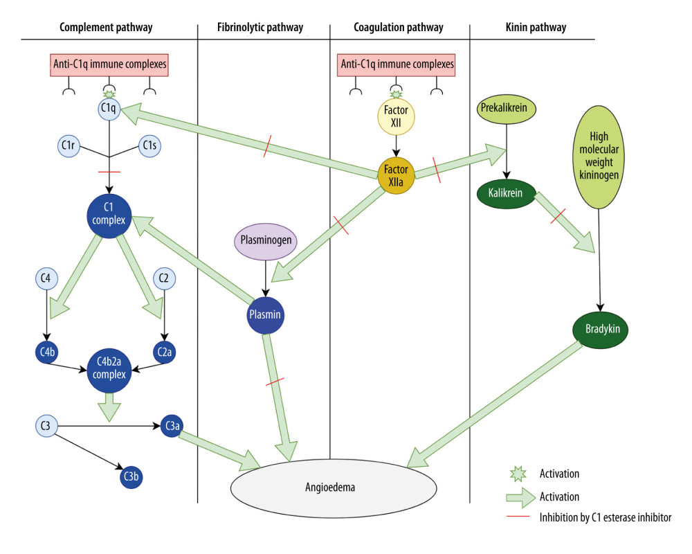Proposed complement-mediated pathways in lupus-associated angioedema. Autoantibodies directed against C1q form immune complexes that may activate (green starburst/arrow) the classical complement pathway and may also promote contact system (kallikrein-kinin) activation. Binding of anti-C1q immune complexes to C1q may activate the C1 complex (C1r/C1s), leading to cleavage of C4 and C2 and formation of the C3 convertase (C4b2a complex) with generation of anaphylatoxins such as C3a, which may augment vascular permeability. In parallel, contact system activation (Factor XII → XIIa) may promote conversion of prekallikrein to kallikrein, which cleaves high-molecular-weight kininogen to generate bradykinin, a major mediator of edema. Plasmin may further amplify these cascades by enhancing complement activation. Because C1-INH normally inhibits (red dash) C1r/C1s, XIIa, kallikrein, and plasmin, dysregulation of these pathways can result in excess bradykinin and complement mediators that could contribute to angioedema. The precise mechanism underlying this phenotype remains incompletely understood.
