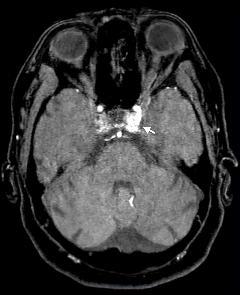 Axial time-of-flight magnetic resonance angiography. Arrow: Arterialized flow within the left cavernous sinus on the time-of-flight sequence.