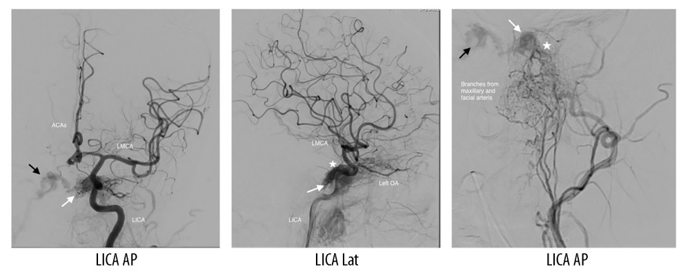 Early opacification of the left cavernous sinus during transarterial injection of the left internal carotid artery (LICA) on anteroposterior (AP) and lateral (Lat) views. Early but less intense opacification is also evident on AP views after left external carotid artery (LECA) injection. White arrow: early filling of the left cavernous sinus on ipsilateral LICA injection; black arrow: early filling of the right cavernous sinus on LICA injection; star: fistula point. Additional abbreviations: LMCA, left middle cerebral artery; ACAs, anterior cerebral arteries; OA, ophthalmic artery.