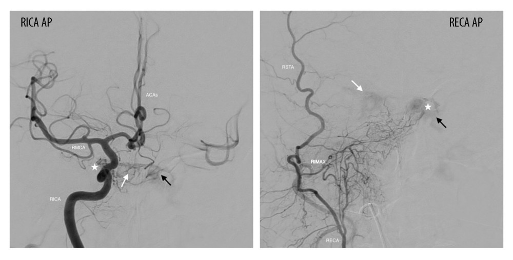 Filling of the left cavernous sinus after right internal carotid artery (RICA) injection on the AP view. Less intense filling is also observed on the AP view after right external carotid artery (RECA) injection. White arrow: early filling of the right cavernous sinus on ipsilateral RICA injection; black arrow: early filling of the left cavernous sinus on RICA injection; star: fistula point. Additional abbreviations: RMCA, right middle cerebral artery; ACAs, anterior cerebral arteries; RSTA, right superficial temporal artery; RIMAX, right internal maxillary artery.