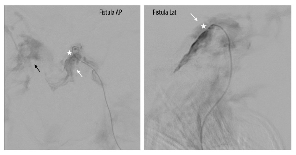 Transvenous injection at the fistula point demonstrates opacification of the left cavernous sinus on anteroposterior (AP) and lateral (Lat) views. White arrow: early filling of the left cavernous sinus on ipsilateral transvenous injection; black arrow: early filling of the right cavernous sinus on left-sided transvenous injection; star: fistula point.