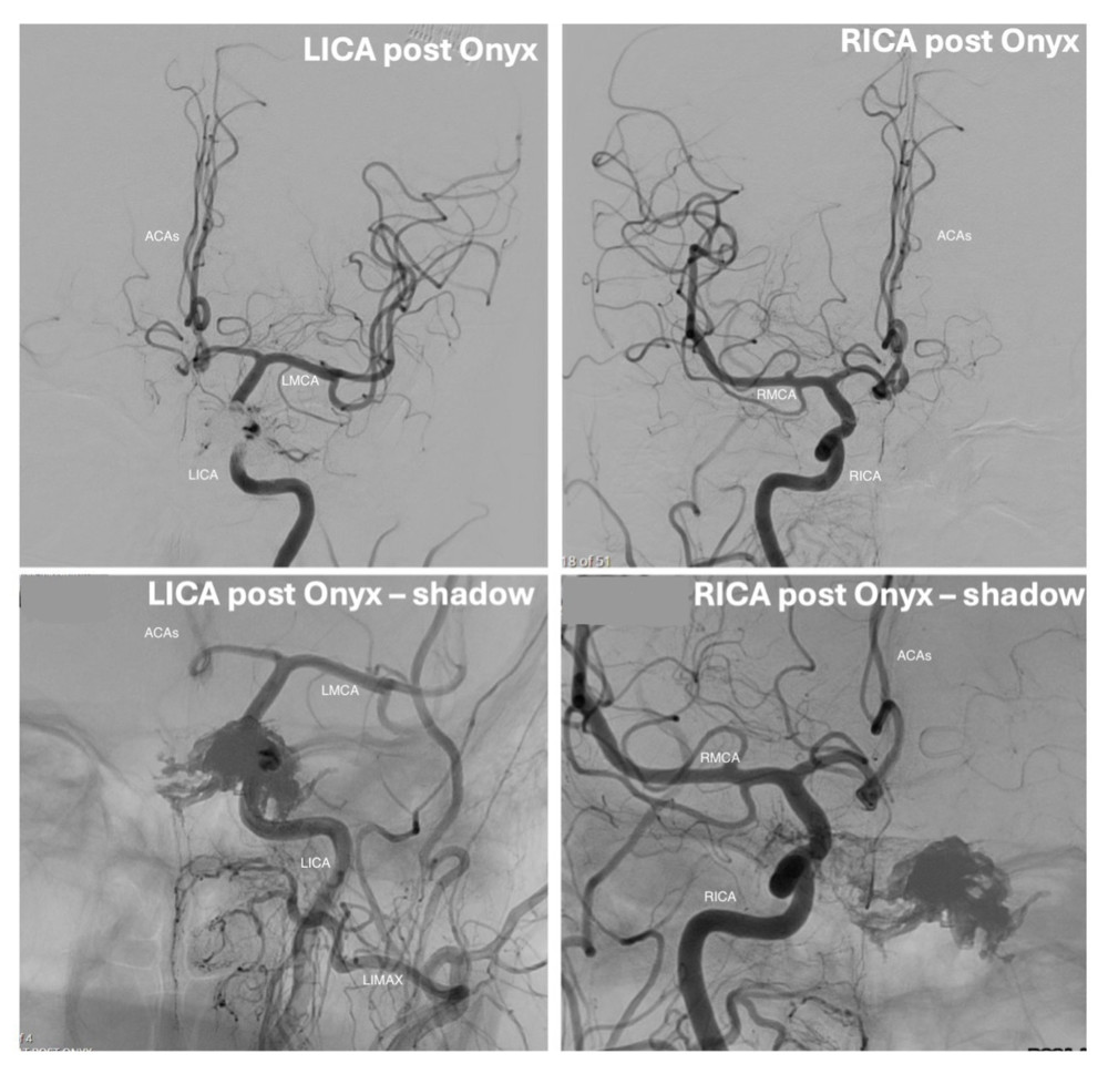 Postembolization digital subtraction angiography demonstrates mixed opacification with the Onyx cast (“shadow”) on transarterial injection. Left internal carotid artery (LICA) injections, including shadow views, show residual flow around the Onyx cast. Right internal carotid artery (RICA) injections, including shadow views, similarly demonstrate partial filling adjacent to the Onyx cast. Additional abbreviations: LMCA, left middle cerebral artery; RMCA, right middle cerebral artery; ACAs, anterior cerebral arteries; LIMAX, left internal maxillary artery.