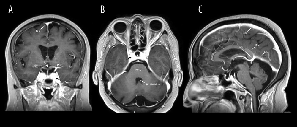 Pre-embolization brain MRI demonstrates the lesion on multiple planes: coronal (A), axial (B), and sagittal (C) T1-weighted post-gadolinium images. Short white arrow: LICA terminus; long white arrow: optic chiasm; black arrow: left cavernous sinus. Additional abbreviations: SSS, superior sagittal sinus; ISS, inferior sagittal sinus; SS, straight sinus; VoG, vein of Galen.