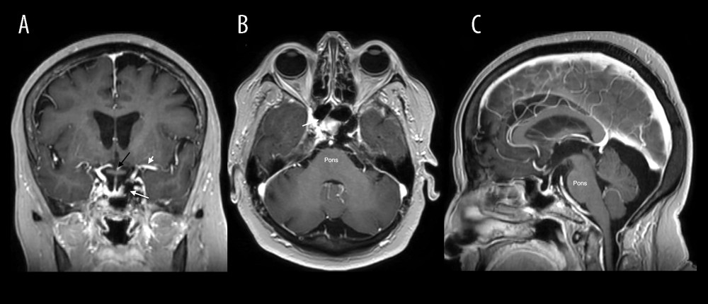 Postembolization brain MRI demonstrates Onyx filling the left cavernous sinus adjacent to the pituitary fossa on coronal (A), axial (B), and sagittal (C) T1-weighted postcontrast images. Short white arrow: LMCA; long white arrow: left cavernous sinus containing Onyx; black arrow: optic chiasm. Additional abbreviation: LMCA, left middle cerebral artery.