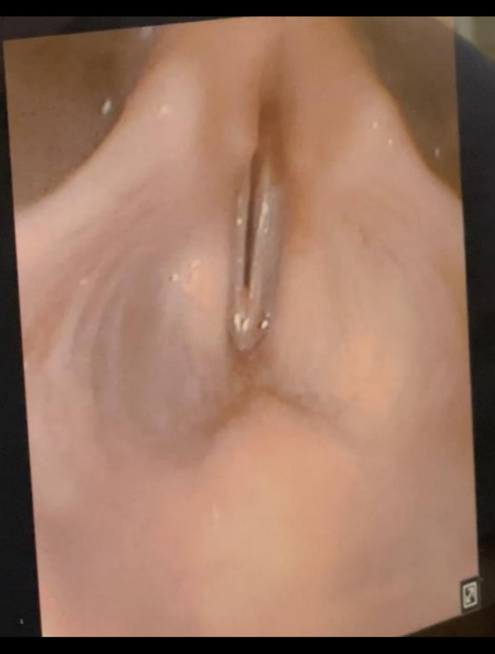 Intraoperative laryngoscopic findings showing adducted vocal cords on inhalation, consistent with diagnosis of paradoxical vocal fold motion disorder.