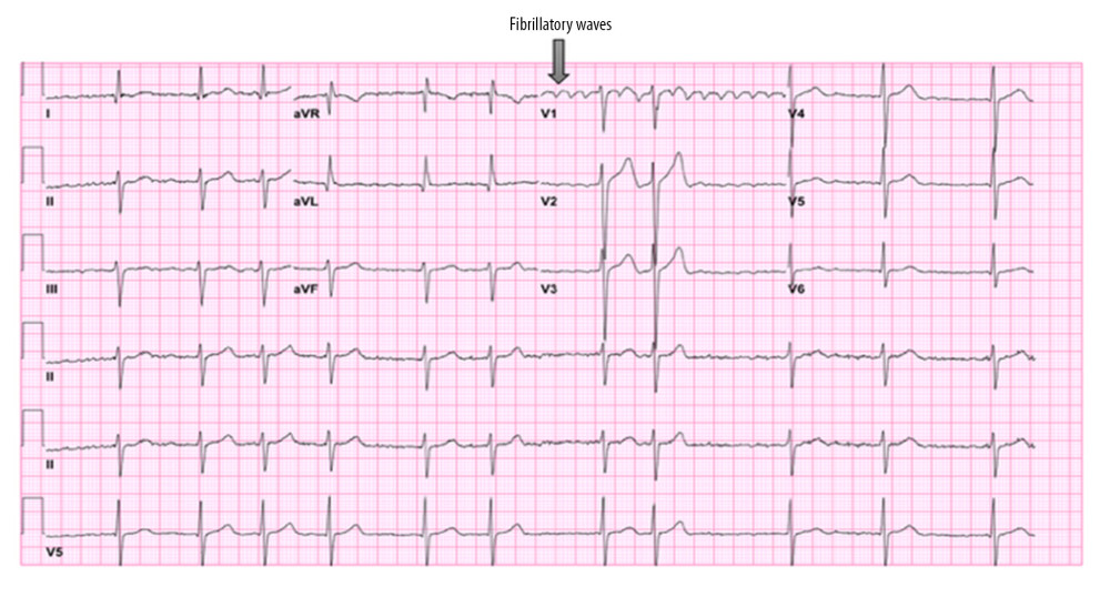 Baseline ECG from patient 1 demonstrating atrial fibrillation with fibrillatory waves in lead V1. The arrow indicates fibrillatory waves.
