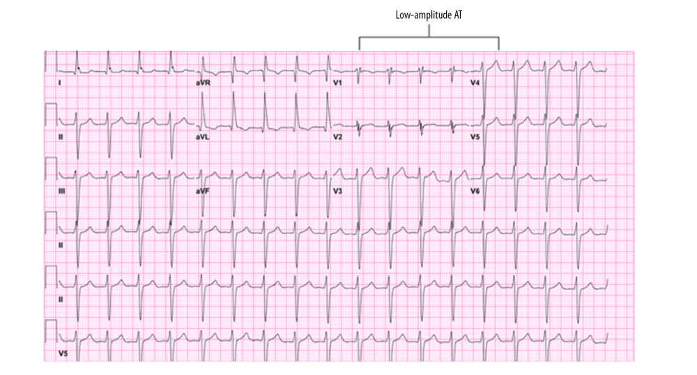 Follow-up ECG from patient 1 demonstrating atrial tachycardia (AT) following prior atrial fibrillation. The arrow indicates low-amplitude AT.