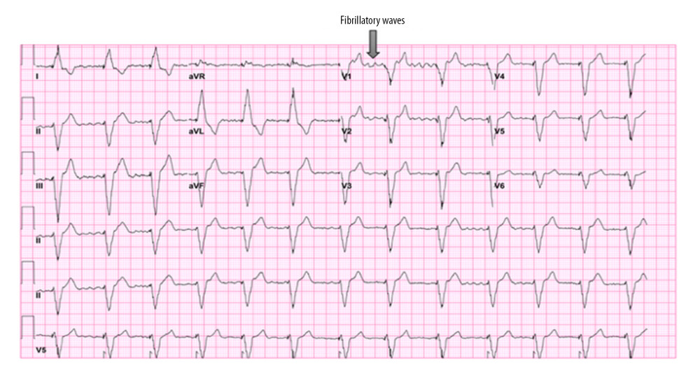 Baseline ECG from patient 2 demonstrating atrial fibrillation with fibrillatory waves in lead V1. The arrow indicates fibrillatory waves.