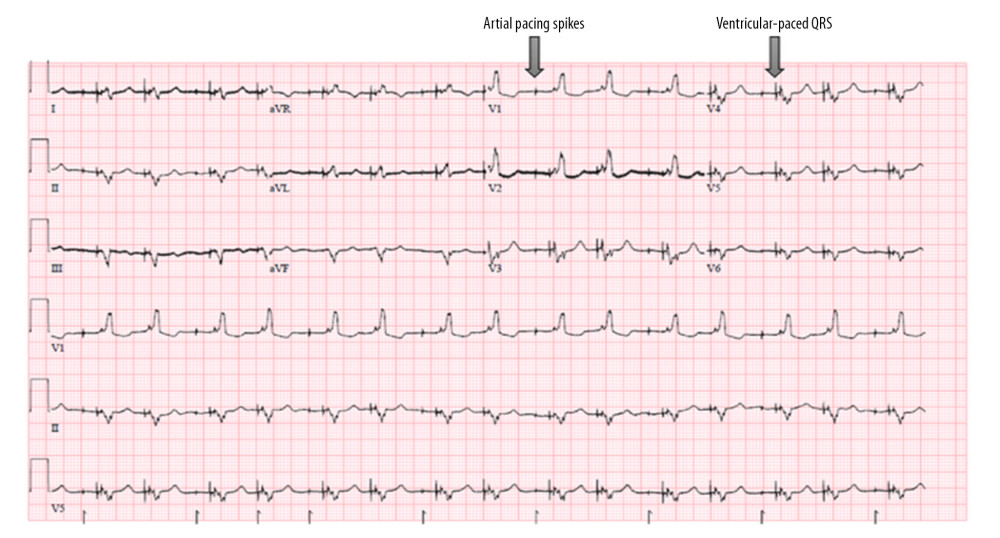 Follow-up ECG from patient 2 with ventricular-paced rhythm and absence of visible atrial activity. Atrial pacing spikes are present without clear evidence of atrial capture. Device interrogation demonstrated absent atrial sensing or capture.