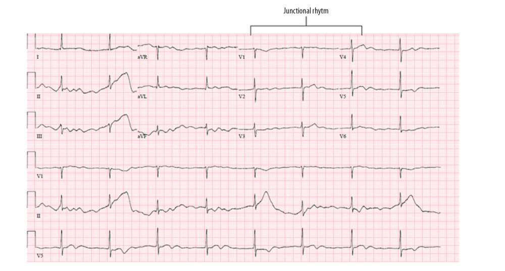ECG from patient 3 demonstrating junctional rhythm without discernible atrial activity. At the time of permanent pacemaker implantation, no atrial sensing or capture could be demonstrated despite assessment of multiple atrial sites.