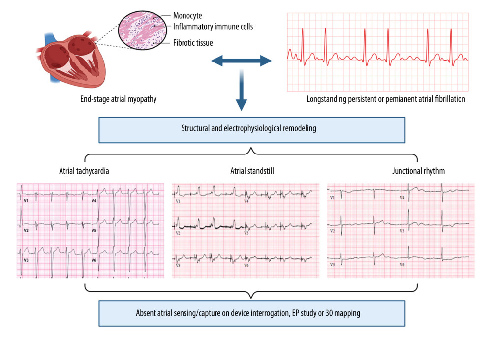 Spectrum of electrocardiographic and arrhythmic manifestations of end-stage atrial myopathy in patients with longstanding or permanent atrial fibrillation.
