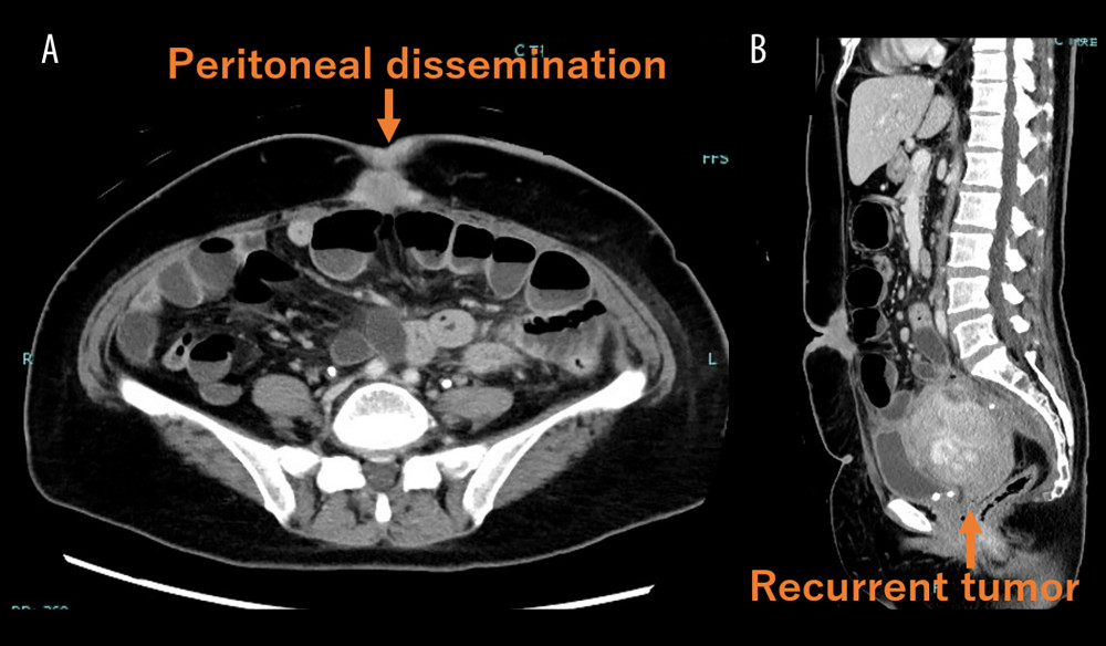 Transverse (A) and sagittal (B) computed tomography images of the abdomen after surgical resection for sigmoid colon cancer, demonstrating peritoneal metastasis around the umbilicus (A) and local recurrence in the sacral region (B).
