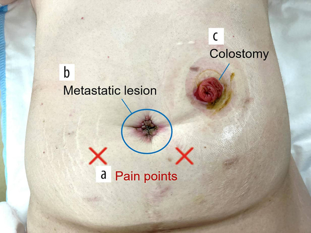 Abdominal inspection findings. a) Pain was localized along the lateral border of the rectus abdominis muscle on both sides of the lower abdomen. The pain was described as stabbing and was exacerbated by movement, particularly during sitting or tensing of the abdominal muscles. b) Peritoneal metastatic lesion around the umbilicus. c) Colostomy on the left side of the abdomen.