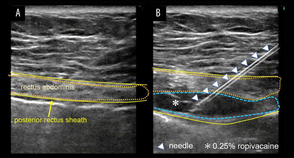 Ultrasound-guided rectus sheath blocks at the points of tenderness. (A) Ultrasound image of the rectus abdominis and posterior rectus sheath. (B) Hydrodissection was performed between the rectus abdominis muscle and the posterior rectus sheath using an in-plane approach from lateral to medial for the rectus sheath blocks.