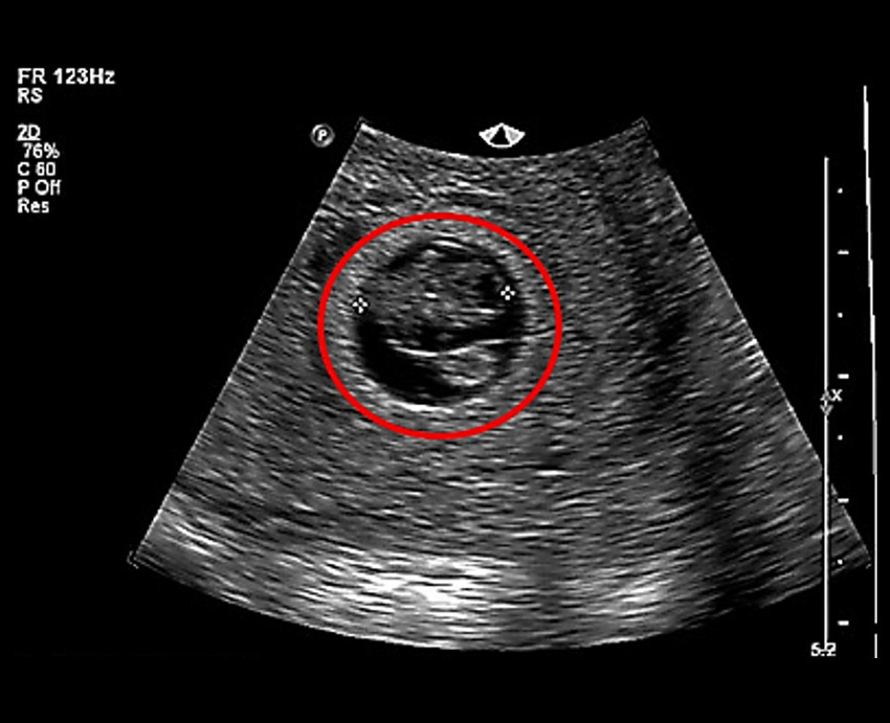 First-trimester diagnostic transvaginal ultrasound confirming structural parameters. The ultrasound demonstrates a restricted gestational sac accompanied by a severe presentation of oligohydramnios (highly deficient amniotic fluid volume).
