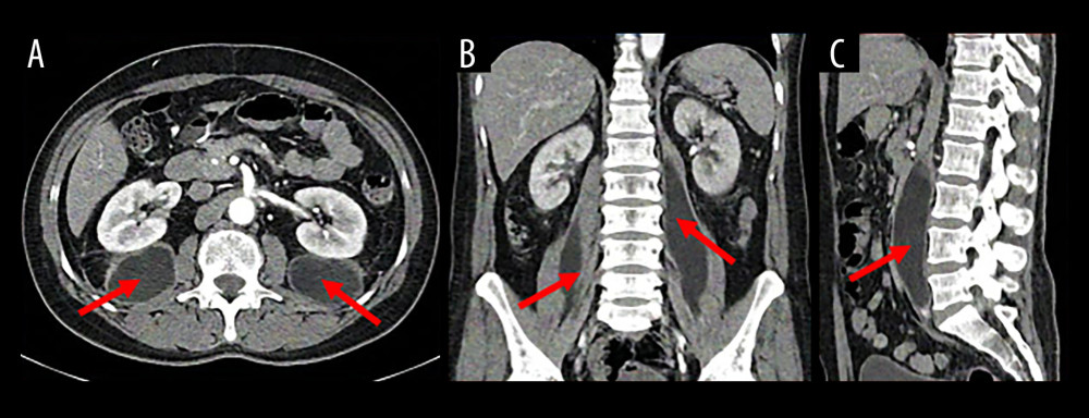 Baseline contrast-enhanced computed tomography angiogram of the abdomen and pelvis. Structural views displayed in the (A) axial, (B) coronal, and (C) sagittal imaging planes reveal well-defined hypodense fluid collections tracking within both the right and left iliopsoas muscles near their distal insertions (indicated by the solid red arrows). Concomitant inflammatory collections are visible within the right external obturator and surrounding regional thigh musculature.