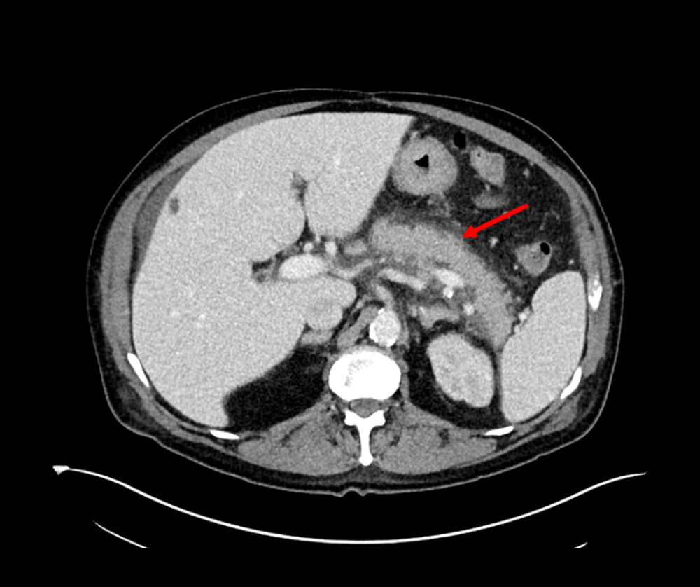 CT scan of abdomen and pelvis showing acute interstitial edematous pancreatitis (red arrow) without evidence of necrosis or fluid collection.