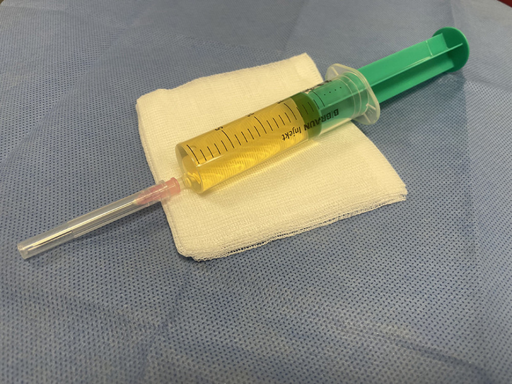 Straw-colored serous fluid obtained by aspiration of the pacemaker pocket.