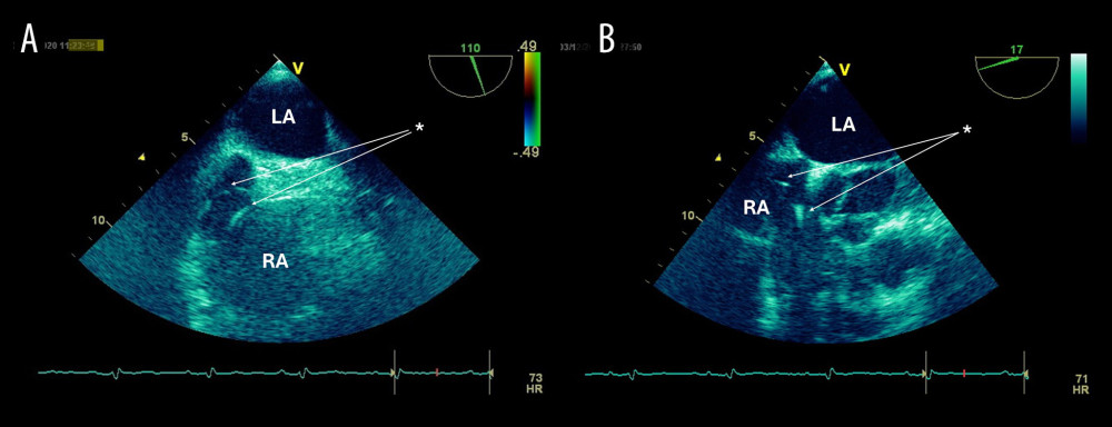 (A, B) Transesophageal echocardiography demonstrating evaluation of the pacemaker leads. No lead-associated vegetations were detected. *, pacemaker lead; LA, left atrium; RA, right atrium.