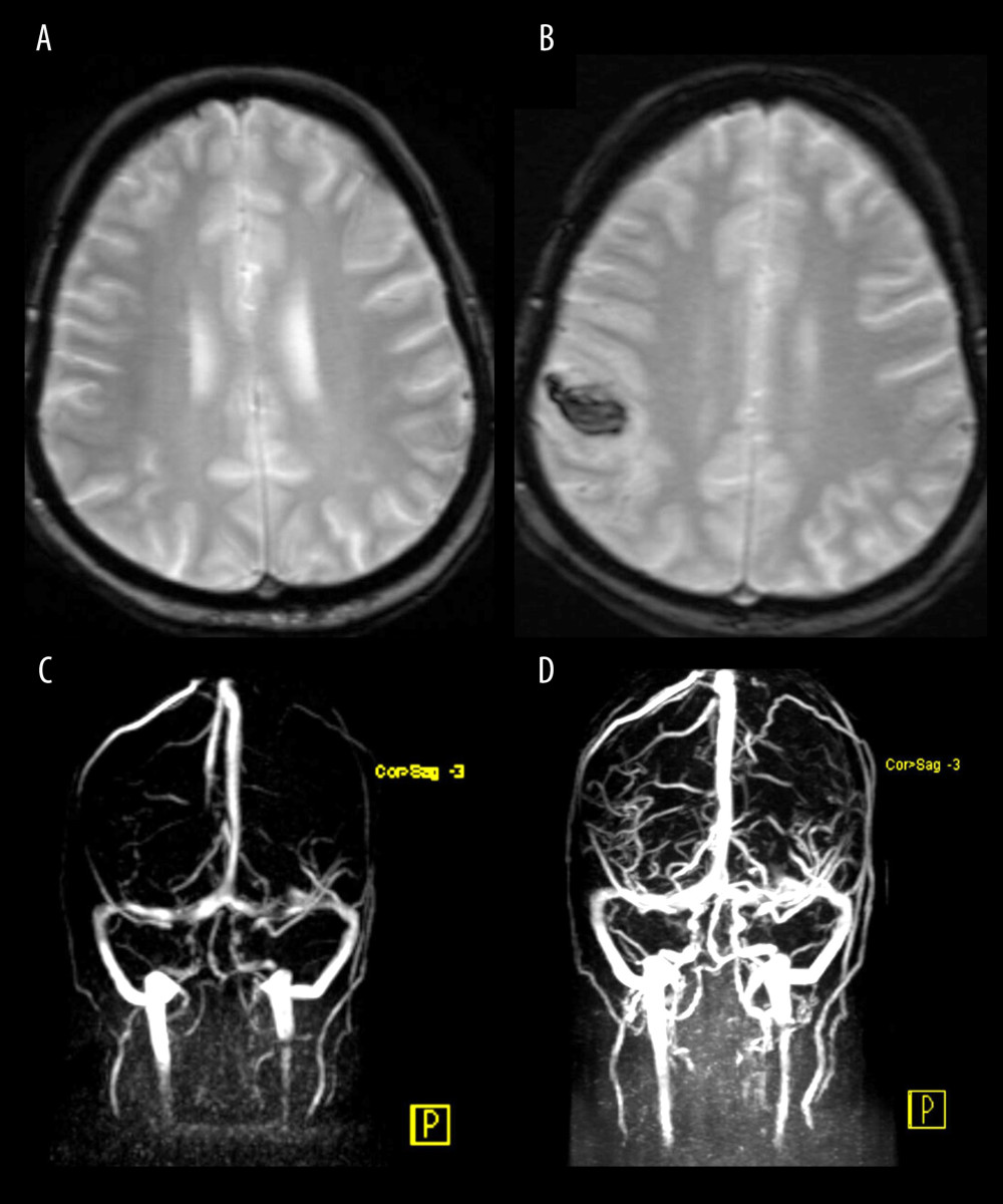 Magnetic resonance imaging (MRI) studies of the brain performed during hospitalization.(A) Contrast-enhanced MRI of the brain on admission demonstrates small, nonspecific foci of altered signal intensity within the bilateral deep and subcortical white matter. No areas of abnormal restricted diffusion are identified. There is no evidence of hyperacute, acute, or early subacute ischemic insult. No extra-axial or intracerebral hemorrhage is seen. (B) Contrast-enhanced MRI of the brain on day 6 of admission reveals a newly developed intra-axial acute hematoma in the right high frontoparietal subcortical region. (C, D) MR venography of the brain performed on day 6 demonstrates occlusion of the right superior anastomotic vein (vein of Trolard), findings consistent with venous hemorrhage.