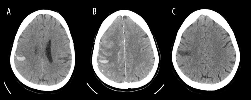 Computed tomography (CT) brain imaging studies performed during hospitalization.(A) Non–contrast-enhanced CT of the brain performed on day 6 following the onset of a generalized tonic-clonic seizure reveals a newly developed intra-axial acute hematoma in the right high frontoparietal subcortical region. Adjacent hyperdense cortical veins are noted, suggestive of thrombosed cortical veins. (B) Follow-up CT angiography of the brain and neck on day 11 demonstrates unchanged right-sided peripherally located hyperdense/thrombosed superficial superior cerebral veins draining to the superior sagittal sinus. Otherwise; no filling defect in dural venous sinuses. Plain CT images show stable multiple foci of intra-axial acute hematoma noted at the right frontoparietal lobe. (C) Follow-up non–contrast-enhanced CT of the brain performed 2 weeks after discharge (day 23) shows interval resolution of the previously noted right frontoparietal intraparenchymal hyperdense hematoma, now appearing hypodense, with resolution of the associated vasogenic edema.