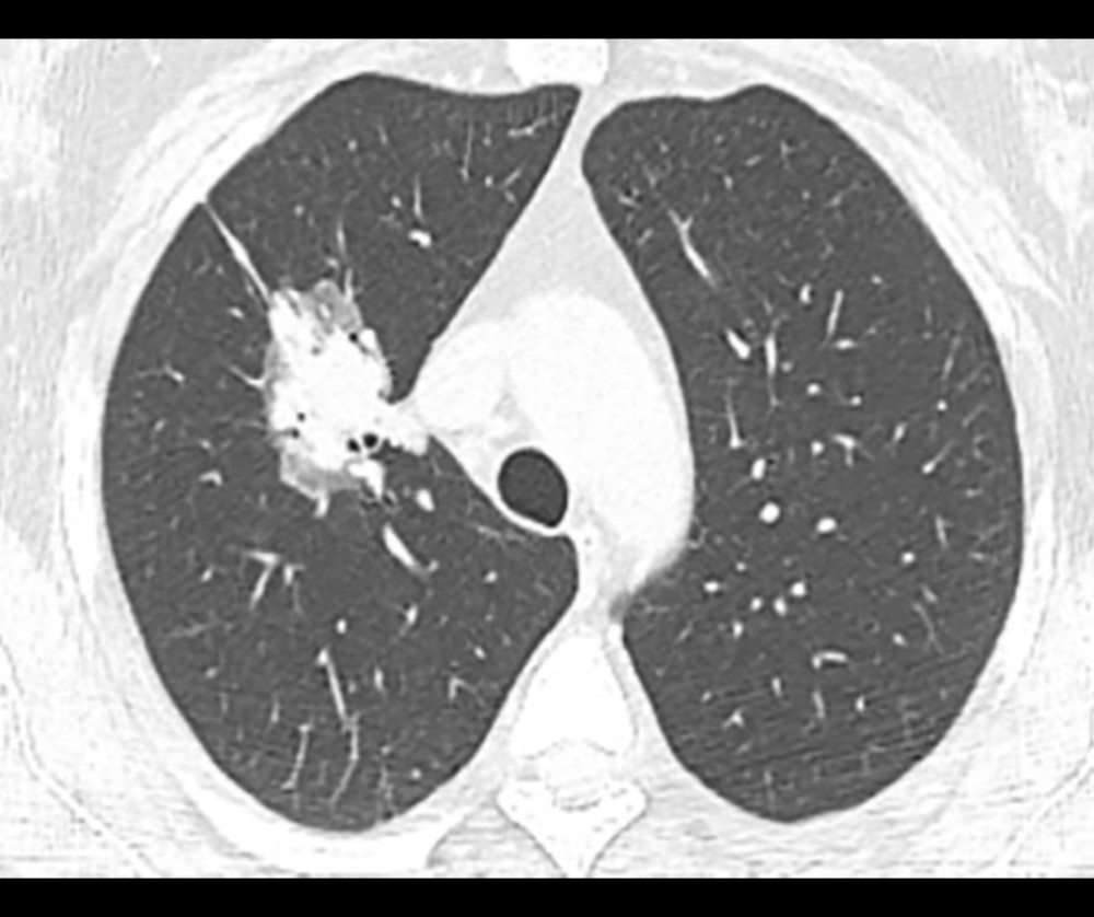 Initial chest computed tomography scan showing a mixed ground-glass and solid lesion in the right upper lobe.