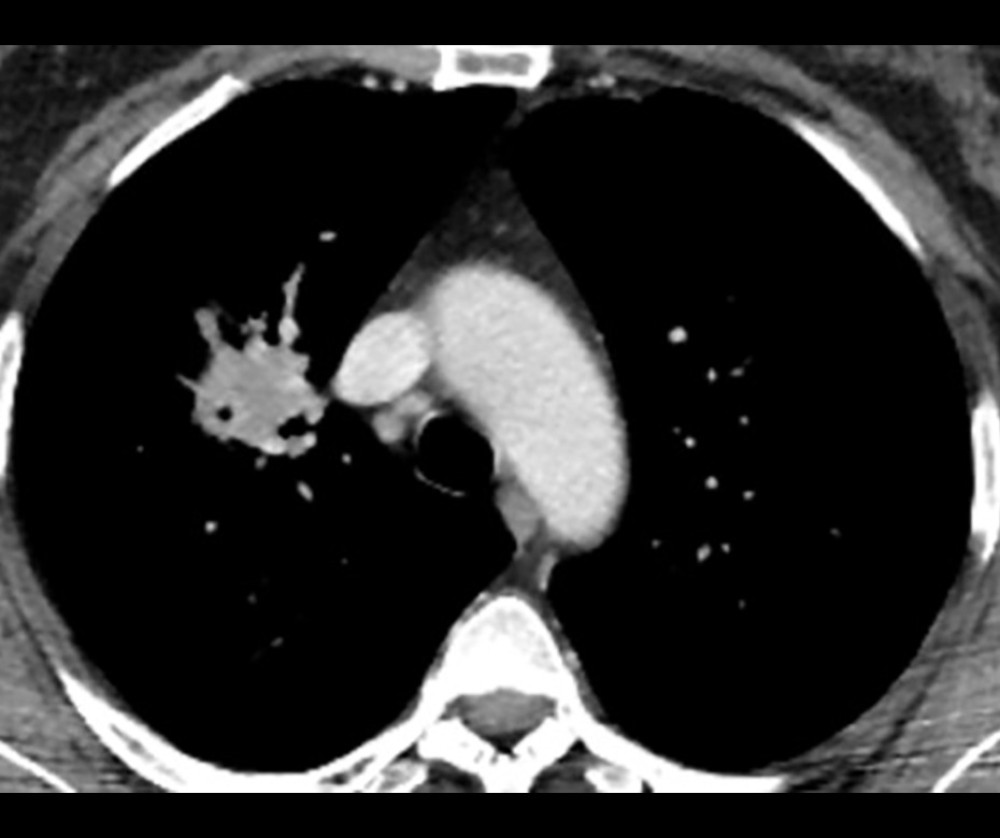Contrast-enhanced chest computed tomography scan highlighting the solid component of the right upper-lobe lesion.