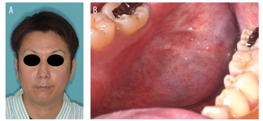 Patient photographs. (A) Extraoral photograph showing no abnormalities. (B) Intraoral photograph showing no inflammatory findings. A faint postoperative scar is observed in the floor of the mouth; the roots were not palpable.