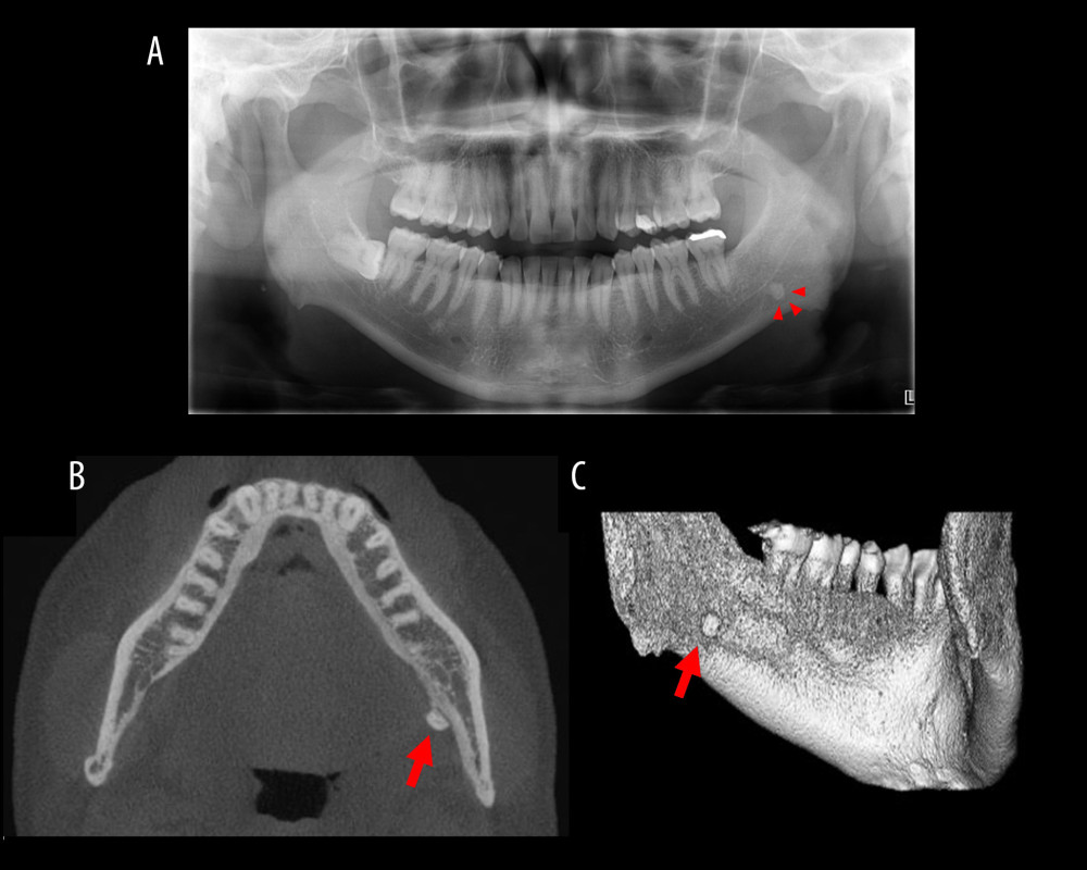 Panoramic radiograph and CBCT images. (A) Panoramic radiograph showing hard tissue on the left side of the mandible. (B) Axial CBCT imaging showing hard tissue on the lingual side of the left mandible. (C) Three-dimensional CBCT image showing hard tissue under the left mylohyoid line. Arrows indicate the displaced tooth fragment.