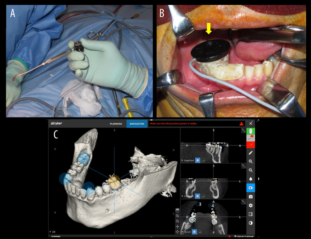 Photograph of the device used for navigation and the screen where the reference point was set. (A) Photograph of a mucosal raspatory set up as a pointer. (B) Photograph of a tracker placed with resin in the intraoral surgical field. (C) Monitor screen when a reference point is set on the teeth.