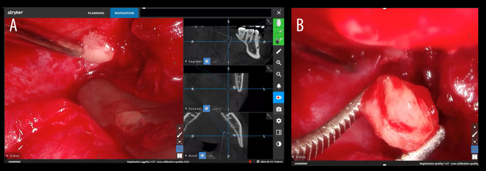 Intraoperative images under navigation. (A) Monitor image showing alignment between the endoscopic view and the fan-shaped field on the CBCT image. (B) Endoscopic view of the extraction of the tooth fragment.