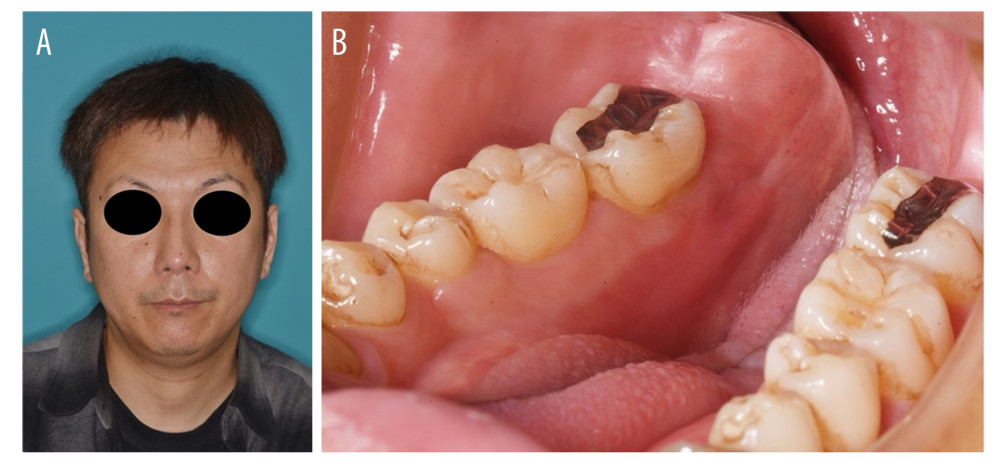 Photographs at 2 weeks after the surgery. (A) Extraoral findings were normal. (B) Intraoral findings were normal, with no wound abnormalities or lingual neurological symptoms.