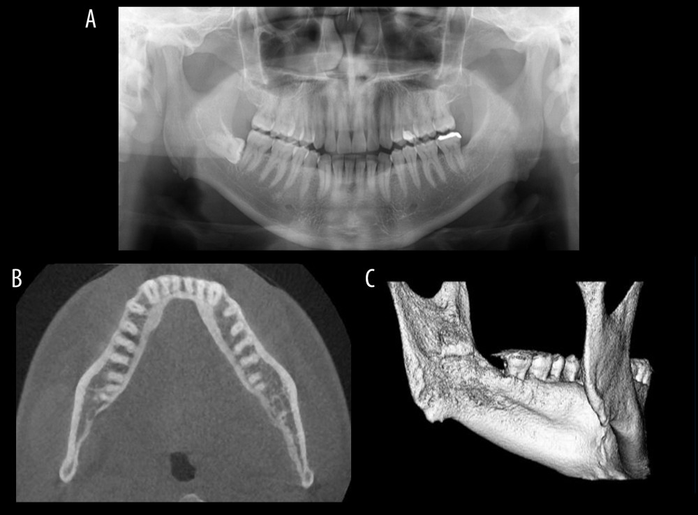 Postoperative imaging. (A) Panoramic radiograph showing complete removal of the tooth fragment. (B) Axial CBCT image. (C) Three-dimensional CBCT image.