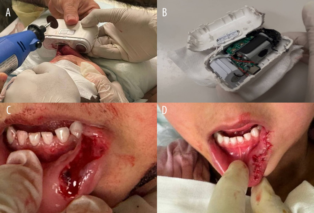 Case 1—Lower lip entrapment in a motorized electric nail trimmer in a 4-year-old girl and subsequent repair.(A) The device attached to the lower lip in the emergency department, with the lip drawn into the aperture on the underside of the device. The battery had already been disconnected, and a handheld rotary cutting tool (left) was applied to the outer casing away from the entrapped tissue; the surrounding face was protected by gauze. (B) The same device after the casing had been opened, showing the exposed battery and circuit board; the internal wheels were then manually rotated to release the lip. (C) The lower lip immediately after release, showing a deep, jagged, full-thickness laceration with tissue loss. (D) The same lip after irrigation and primary closure with 5-0 absorbable sutures under local infiltration anesthesia. All images were obtained during the index emergency department visit.