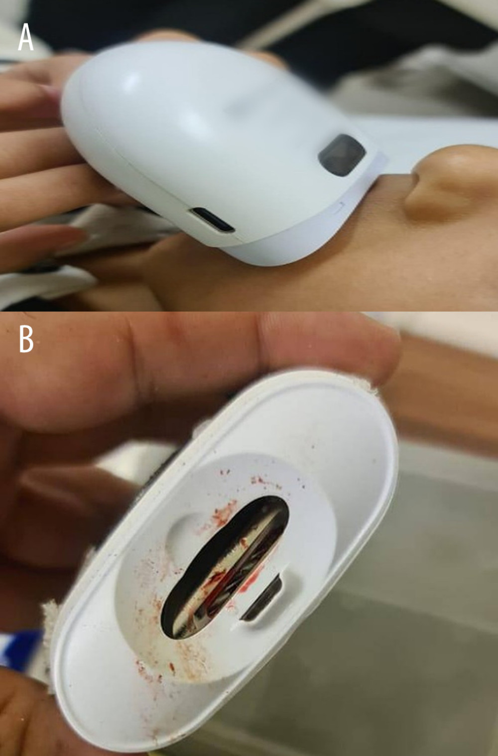 Case 2—Upper lip entrapment in a motorized electric nail trimmer in a 3-year-old boy.(A) The device attached to the upper lip on arrival at the emergency department, with the lip held between the rotating mechanism and the plastic guard of the device; manufacturer markings on the casing have been obscured. (B) The same device after removal, viewed from the underside, showing the oval aperture and rotating element within the aperture; blood staining is visible at the aperture margin. Both images were obtained during the index emergency department visit.