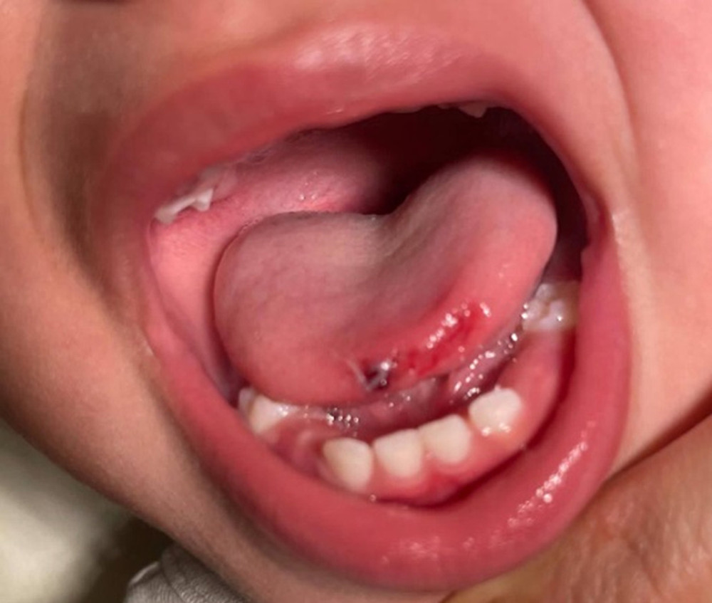 Case 3—Superficial tongue abrasion from a motorized electric nail trimmer in a 2-year-old girl.A superficial linear abrasion at the anterior tip of the tongue, without extension into the underlying muscle or involvement of the lips, teeth, or buccal mucosa. The device had become detached before arrival. The image was obtained during the index emergency department visit; the wound was managed conservatively without suturing.