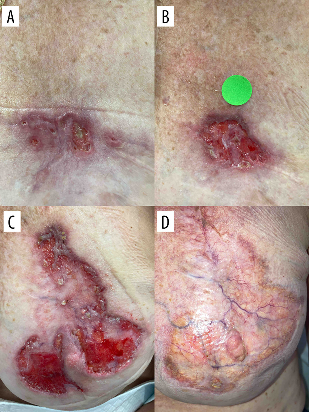 Clinical progression of the left breast lesion. (A) Initial presentation of the nonhealing left superior breast ulcer, measuring approximately 1.0 × 3.0 cm at the time of initial wound clinic evaluation. (B) Interval enlargement following serial debridement, with the lesion increasing to approximately 4.5 × 3.5 cm. (C) Peak lesion size prior to initiation of immunosuppressive therapy, measuring approximately 10.0 × 10.5 cm. (D) Complete resolution after initiation of immunosuppressive therapy. Images were obtained during routine clinical care; therefore, acquisition distance, angle, lighting, and scale were not fully standardized.