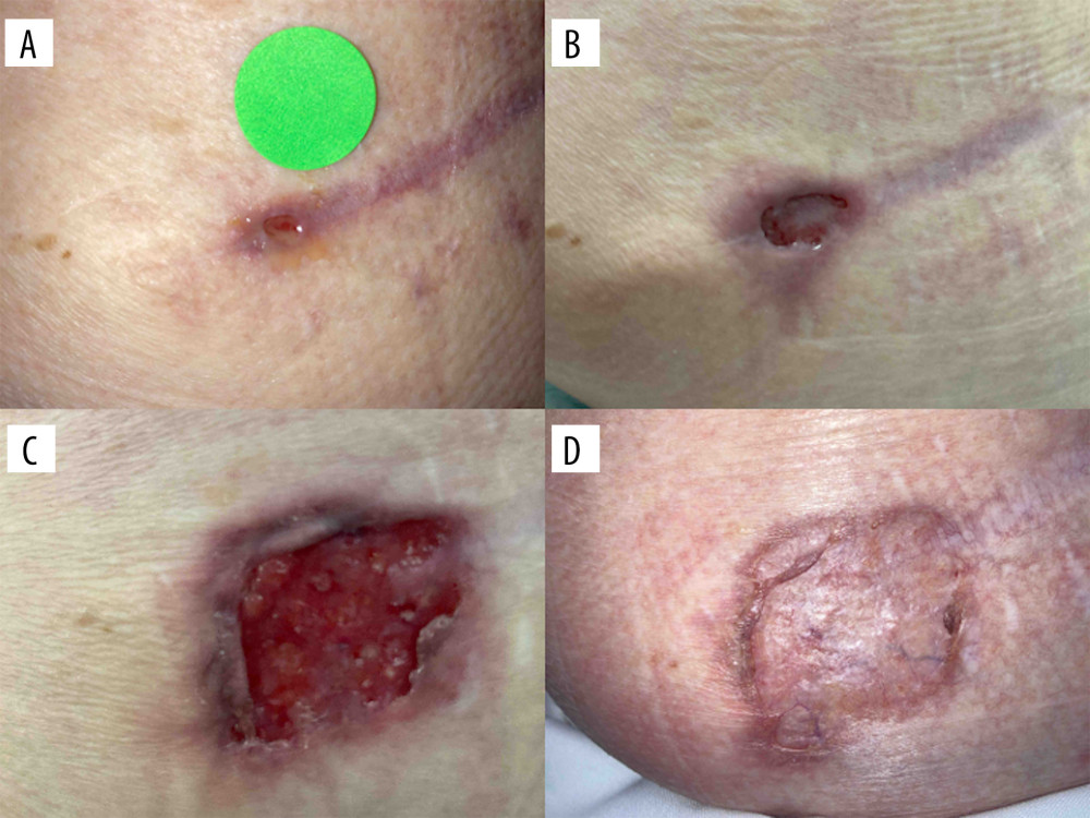 Clinical progression of the left lower back lesion. (A) Reopening of the left lower back wound, initially measuring approximately 0.2 × 0.5 cm. (B) Interval enlargement of the lower back lesion to approximately 0.9 × 1.2 cm. (C) Maximum lesion size prior to initiation of immunosuppressive therapy, measuring approximately 2.0 × 2.5 cm. (D) Complete resolution following immunosuppressive therapy. Images were obtained during routine clinical care; therefore, acquisition distance, angle, lighting, and scale were not fully standardized.