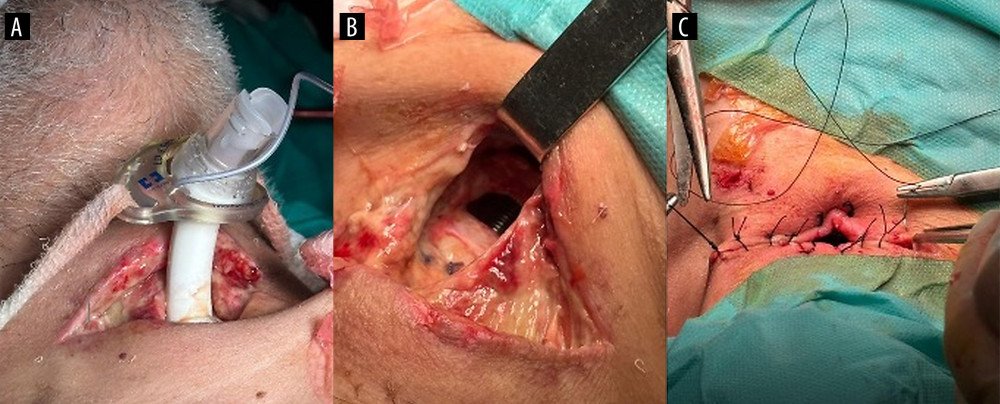 Sequence of intraoperative events. (A) Malpositioned tracheostomy following wound dehiscence and reopening of purulent tissue. (B) Endotracheal tube visualized through the anterior tracheal stoma after emergent orotracheal intubation and tracheostomy cannula removal. (C) Final appearance of the tracheostomy after surgical repair, prior to insertion of a new tracheostomy cannula.