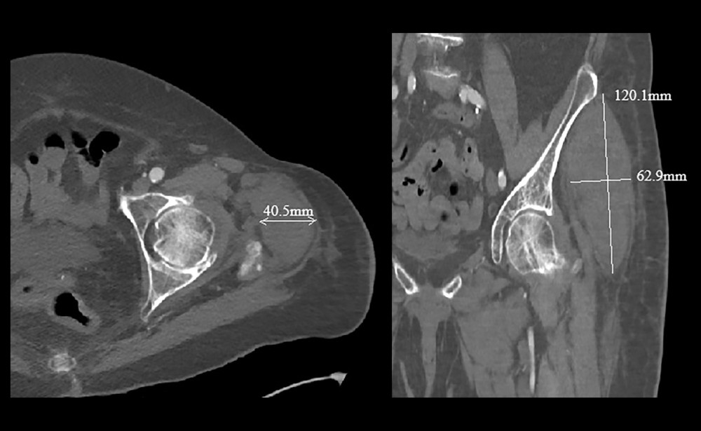 CTA of left lower extremity demonstrating intramuscular hematoma within the left gluteus minimus muscle belly measuring 4.1 × 6.3 × 12 cm in axial (left image) and sagittal (right image) views. CTA, computed tomography angiography.