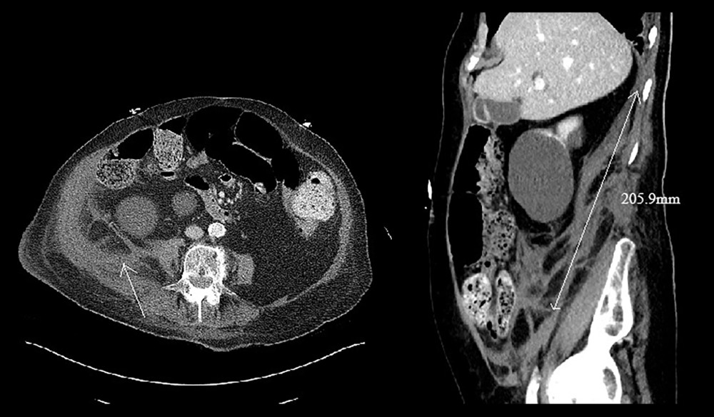 Abdominal and pelvic CT with contrast demonstrating right retroperitoneal hematoma extending from the posterior tip of the liver to the right lower pelvis. The hematoma measured 20.5 cm in the craniocaudal dimension, as is demonstrated on the sagittal plane in the right-side image. The pointer line on the left-side image demonstrates the same, in axial view.